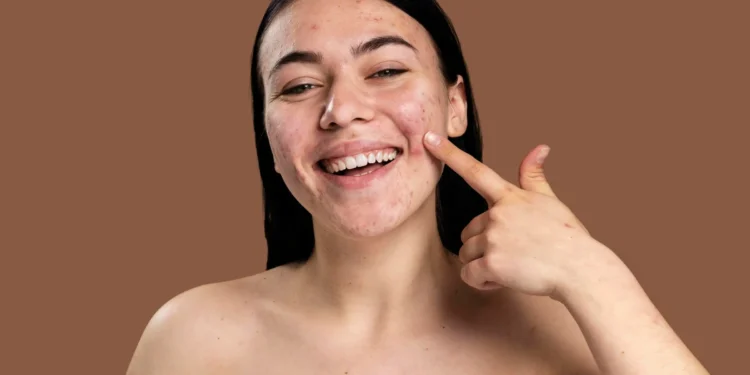 smiley-woman-showing-her-pimple-with-confidence